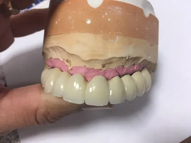 prothèse implantée