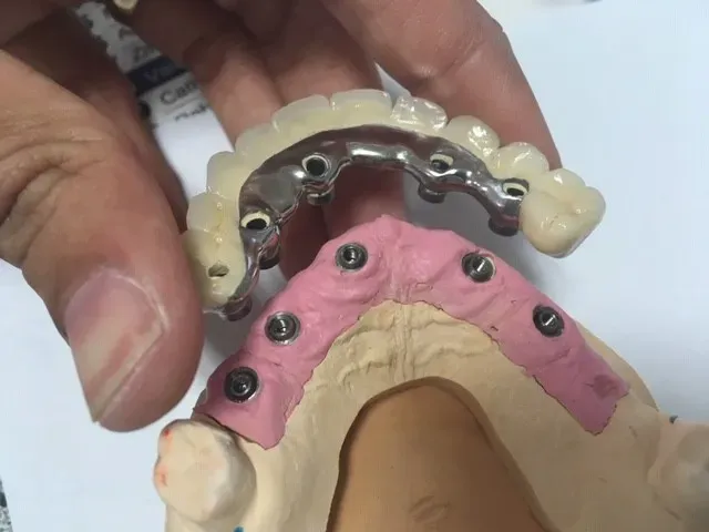 prothèse implantée