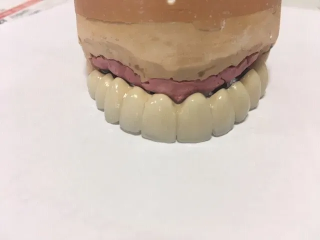 prothèse implantée